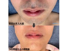 インプレス(impress)の雰囲気（回数を重ねることで青ヒゲが目立たなくなり、清潔感ある印象へ♪）