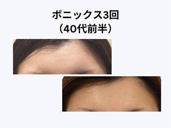 アユアラングレース/40歳前半・3回/額の横シワ消失!