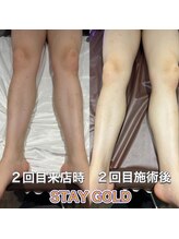 ステイゴールド 新百合ヶ丘(STAY GOLD)/足脱毛！夏までにまずはお試しを