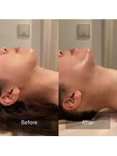 アラマンダ(Allamanda)/顎下吸引BeforeAfter