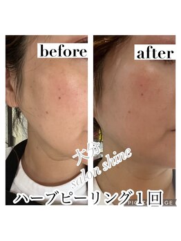 サロンシャイン(Salon Shine)/REVIハード１回ハーブ