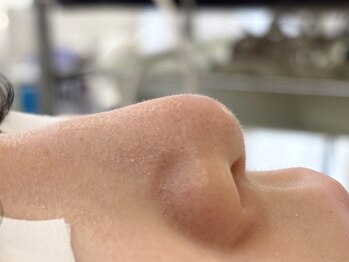 シェリーガーデンの写真/【角栓・黒ずみが気になる方】毛穴を徹底洗浄！ハイドロフェイシャルで透明美肌へ★