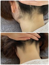 ベリッシモ(bellissimo)/うなじ美肌脱毛