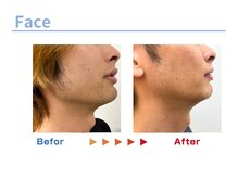 キングスサロン 熊本/メンズ髭脱毛ビフォーアフター