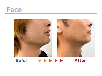 キングスサロン 熊本/メンズ髭脱毛ビフォーアフター