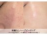【6/11限定】陶器肌お顔ハーブピーリング¥3980～※お悩み別カスタムも可能