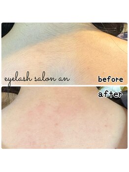 アン(an)/背中Wax