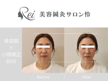 怜(Rei)の写真/京橋NEWOPEN!どんな顔型の方も"小顔"に導く圧倒的な技術◎美容鍼とのSETも人気★美容鍼灸&小顔矯正サロン