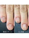 自爪育成3ヶ月コース