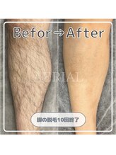 エアリアル 大牟田店/MENSボディ脱毛(ひざ下)