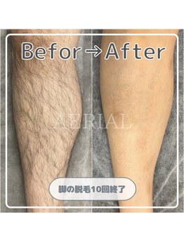 エアリアル 大牟田店/MENSボディ脱毛(ひざ下)