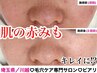 【毛穴と肌の赤みが気になる方に◎】敏感肌の方の肌質改善特別コース¥12,500