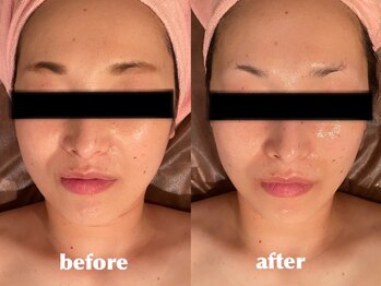 エステティックサロン フェアリー(ESTHETIC SALON FAIRLY)/Vリフト小顔矯正Before→After