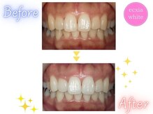 エクシアホワイトニング 原宿店/ホワイトニングビフォーアフター