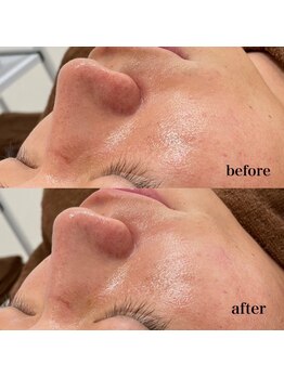 ホワイトラボ 梅田(White labo)/【施術例】ハイドロフェイシャル