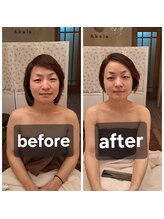 アカラ(Akala)/小顔矯正 週1、4回施術
