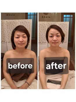 アカラ(Akala)/小顔矯正 週1、4回施術