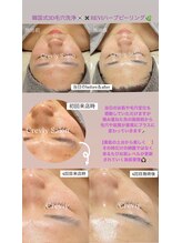 クレヴィー(Creviy)/韓国式3D毛穴洗浄＆REVlハーブ