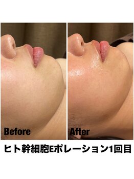 Sスタイルスタジオ 福岡天神/エレクトロポレーション1回目