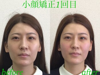 オズ六本木/小顔モニター大募集@オズ六本木