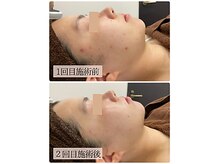 リノン(LINON)/ハーブピーリング 施術回数２回