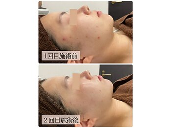 リノン(LINON)/ハーブピーリング 施術回数2回