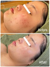 エクセレントビューティーサロン 艶(EN)/ニキビ・シミ・肌荒れ・赤み改善