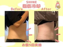 シャイン(SHINE)