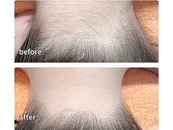 柏ベルミーランド/脱毛before→after