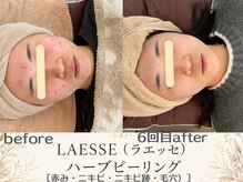 エスポワール(espoir)/学生時代から続くニキビに(正面)