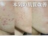 繰り返す肌トラブルに【本気のニキビケア/肌質改善】REVIハーブピーリング