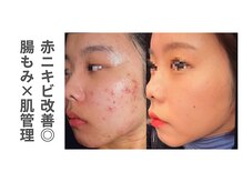 ソルレ 宮崎店(SOLURe)/赤ニキビ改善◎腸もみ×肌管理