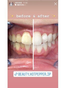ホワイトニングビューティー 名古屋栄店(WHITENING BEAUTY)/セルフホワイトニング