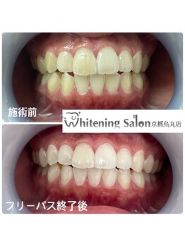 ホワイトニングサロン 京都烏丸店/ホワイトニング施術例