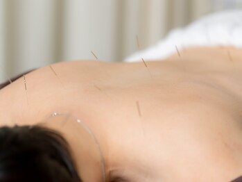 溝口鍼灸整骨院/鍼施術