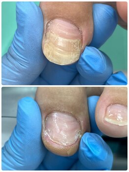 【大阪・京橋】【二枚爪】変形爪