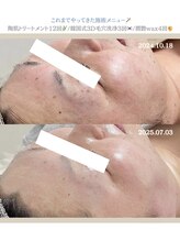 クレヴィー(Creviy)/ハーブ×毛穴洗浄×wax継続変化