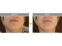 ポノ(pono)/WINBACKフェイシャル　二重顎