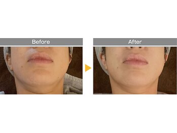 ポノ(pono)/WINBACKフェイシャル　二重顎