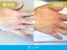 【初回限定】全身脱毛2ヵ所脱毛体験（手の甲・指）&無料カウンセリング