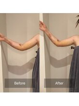 アラマンダ(Allamanda)/二の腕吸引BeforeAfter