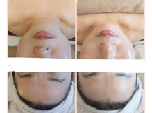 ヨリーズサロン 渡辺通(yoris.salon)の雰囲気（ポールシェリー　アトニックフェイシャルでたるみ改善スッキリ♪）