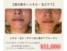 【部分ニキビ・毛穴悩みに】つるんと素肌ケア◎ハーブ導入 ¥11,000