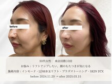 エメ 名古屋栄店(aimer)/LiftCare <小顔・リフトアップ>