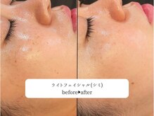 レオロ(leolo)/シミ改善に！