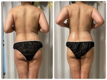 美 プラス(美 Plus)/【30代】背中の歪み