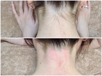 カルム(Calme)/うなじ脱毛