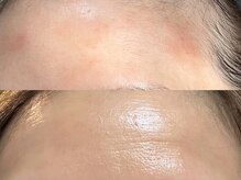 イルガドット 897(ilga.897)/赤み　痒み　１日での変化