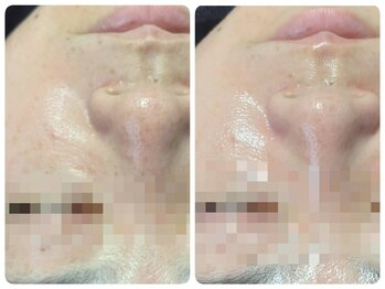 トータルビューティ ノイド(Noid)/毛穴洗浄　お試し全顔