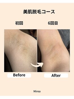 ミレア(Mirea)/ワキ脱毛なら施術は10分☆